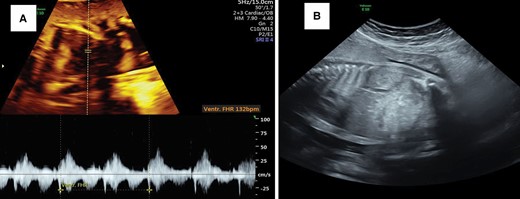 (A) Cardioversion to a sinus rhythm 12 h after intraperitoneal amiodarone. (B) Resolution of hydrops (ascites) 2 weeks after the procedure.