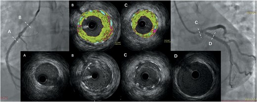 Virtual-histology intravascular ultrasound showing a rapid (within 2 months) and homogeneous in-stent fibrosis (B and C) but normal extra-stent vessels (A and D).