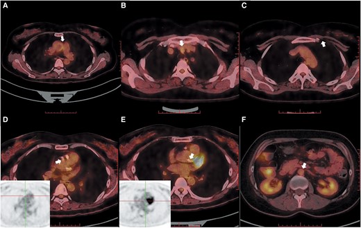 18F-fluorodeoxyglucose-positron emission tomography/computed tomography of large vessels. (A) High 18F-fluorodeoxyglucose uptake in the left margin of the ascending aorta. (B) High 18F-fluorodeoxyglucose uptake in the brachiocephalic trunk. (C) No significant uptake in the left internal mammary artery area. (D) No significant uptake in the ostial left main. (E) No significant uptake in the ostial right coronary artery. (F) No significant uptake in the abdominal aorta.
