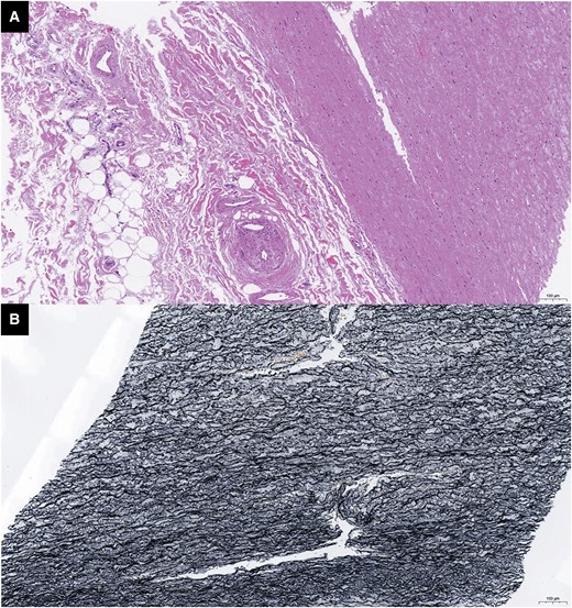 Pathology of the ascending aorta after coronary artery bypass graft. (A) H&E dyeing: there was no obvious intimal hyperplasia or inflammatory cell infiltration in the ascending aorta media layer. (B) Elastic fibre dyeing: the elastic fibres were aligned with no necrosis in anastomosis of asending aorta.