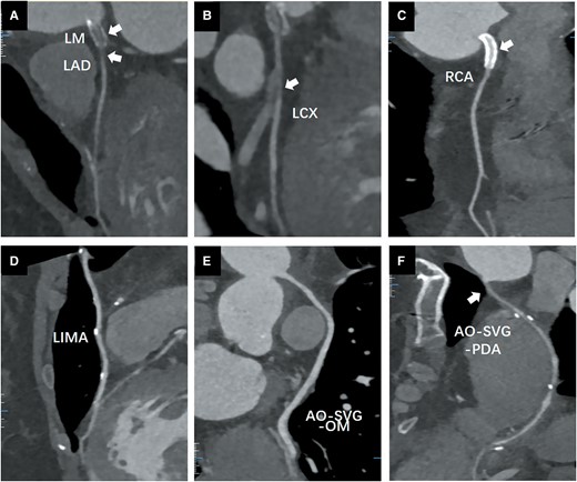 Coronary computed tomography angiography after 1 year of coronary artery bypass graft. (A) Left main and left anterior descending artery stent occlusion; (B) left circumflex (LCX) proximal segment occlusion; (C) right coronary artery ostial stent was not stenosed. (D) Left internal mammary artery was not stenosed. (E) Aorta (AO)-saphenous vein graft-LCX was not stenosed. (F) Proximal AO-saphenous vein graft-OM anastomosis was stenosed.