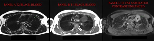 Cardiac magnetic resonance (MR). (A) In T2 black blood (BB), mass is hypointense with hyperintense rim; (B) in T1 turbo spin echo (TSE) BB, mass is hyperintense. (C) T1-TSE fat saturated with contrast (FS C+) shows a better view of the hypointense core without contrast enhancement. MR, magnetic resonance; BB, black blood; TSE, turbo spin echo.