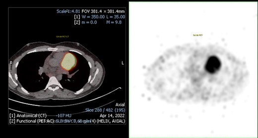 68Ga positron emission tomography (PET). On the left, PET-CT fusion imaging that shows the presence of mediastinal uptake in correspondence of the mass (SUV max 33.7). On the right, non-fusion PET image. PET, positron emission tomography