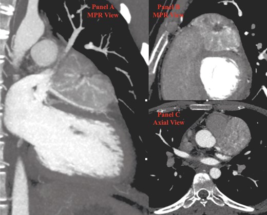 Cardiac computed tomography (CT). (A) In the first multiplanar reconstruction (MPR) view, the course of left anterior descending (LAD) artery is indissociable from the inferior surface of the paraganglioma (PGL). (B) The second MPR view shows the typical aspect of PGL with a central hypodense scar surrounded by an inhomogeneous enhancing tissue. (C) Axial view. CT, computed tomography; LAD, left anterior descending; PGL, paraganglioma.