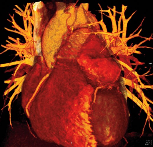 3D image of the mass and its relationship with left anterior descending (LAD). LAD, left anterior descending.