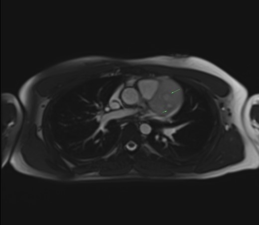Salt and pepper appearance on SSFP (steady state free precession) cine sequences. Long arrow: enhancing parenchyma of the mass (salt). Short arrow: signal flow voids of the vessels (pepper).