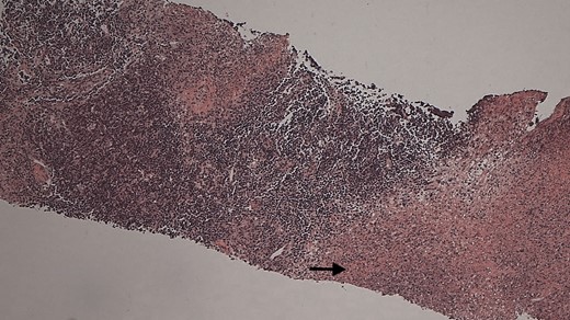 Histopathology of lymph node core biopsy. Evidence of areas of necrosis (arrow) which are associated with abundant neutrophils and debris. Occasional fibrin thrombi are noted in small vessels. Features are of suppurative necrotizing lymphadenitis with a wide differential diagnosis including Kawasaki disease.