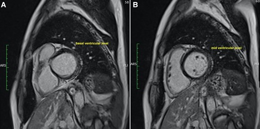 Cardiac magnetic resonance imaging with post contrast (gadolinium) imaging showing a confluent stripe of mid-wall fibrosis in the inferolateral/lateral wall at the basal level (A) as well as some patchy inferolateral mid-wall fibrosis at the mid-ventricular level (B).