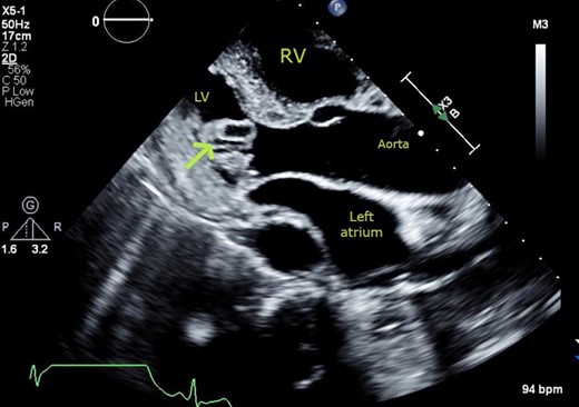 Transthoracic echocardiogram. Parasternal long-axis view showing cystic mass (arrow) with echo-lucent core, protruding into the left ventricular cavity from the basal infero-lateral wall.