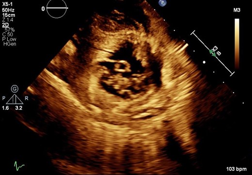 Transthoracic echocardiogram. Basal parasternal short axis at the mitral valve view showing pedunculated finger-like, cystic mass (2×0.72 cm) protruding into the cavity of the left ventricle. Cross sectional view of mass with echo lucent core.