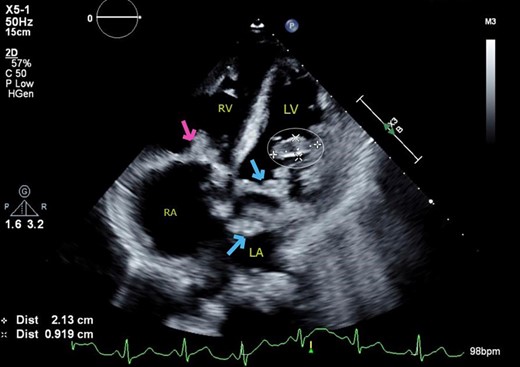 Transthoracic echocardiogram. Apical four chamber view showing cystic mass protruding from the anterolateral wall of the left ventricle into the cavity (cross and circle), along with multiple vegetations (vs. mass) on the mitral valve (arrows) and tricuspid valve (arrow).