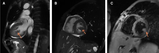 Cardiac MRI. (A) Long axis view: Mass from lateral wall, (B) Mid Short axis view at the level of papillary muscles: Mass from the lateral wall; same intensity as myocardium itself suggesting a solid mass (as compared to TTE where it had an echo-lucent core as if filled with fluid), (C) Gadolinium enhancement: mass enhances in a similar fashion as the lateral wall -> solid mass.