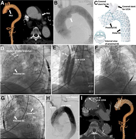 (A) Computed tomography angiography confirmed penetrating aortic ulcer in the aortic arch. (B) Digital subtraction angiography confirmed the diagnosis. (C) Design of the novel double inner-branched device. (D) Deployment of the stent-graft in the ascending aorta. (E) Confirmation of two inner branches with balloons. (F) Deployment of bridged covered stents in the innominate artery and left common carotid artery. (G) Deployment of the distal stent-graft. (H) Final angiography showed procedural success. (I) Computed tomography angiography was followed up for 6 months. PAU, penetrating aortic ulcer; IA, innominate artery; LCCA, left common carotid artery; SG, stent-graft.