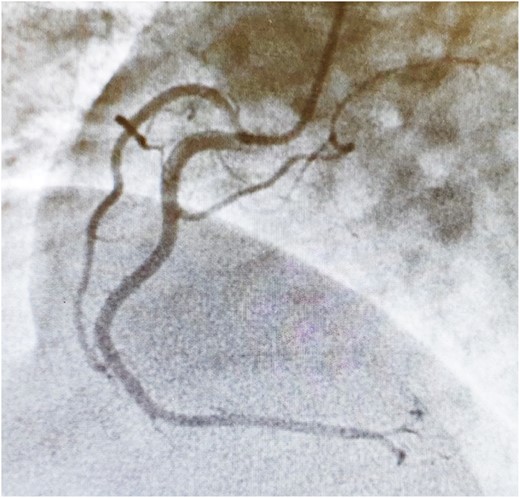 Right coronary angiography.