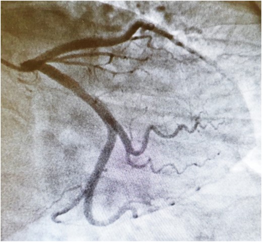 Left coronary angiography.