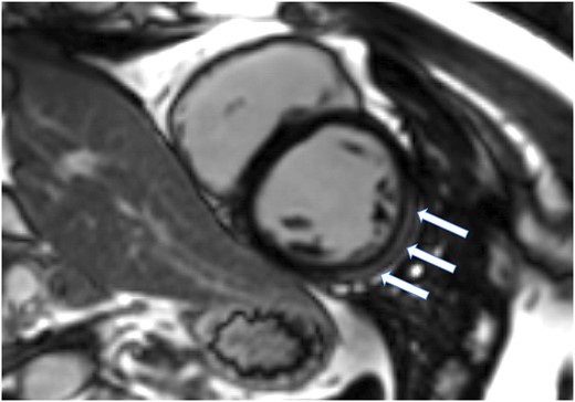 Selected image from cardiac magnetic resonance imaging acquired on 3T Siemens Lumina magnetic resonance imaging scanner. LGE evidence in the mid ventricular antero-lateral and infero-lateral segments (arrows). For more cardiac MRI and ecocardiographic imaging, please find in the Supplementary material online, available at European Heart Journal – Case Reports online.