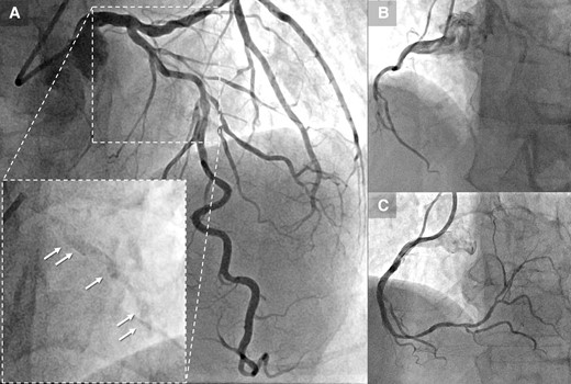 (A) Coronary angiography reveals stenosis with severe calcification in the proximal and mid-segment of the left anterior descending, clearly visible prior to contrast injection (arrow). (B) Sub-total occlusion in the mid-right coronary artery. (C) Post–percutaneous coronary intervention angiography of the right coronary artery. LAD, left anterior descending; PCI, percutaneous coronary intervention; RCA, right coronary artery.