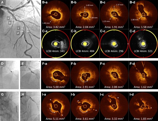 (A) Baseline angiography of the left anterior descending in the first session. (B) Baseline optical coherence tomography shows circumferential calcification with a thickness exceeding 1.0 mm in the proximal (a and b) and mid-lesions (c and d). (C) Near-infrared spectroscopy-intravascular ultrasound showing lipid components inside or behind the calcification (yellow areas). (D) Rotational atherectomy with 1.5 and 1.75 mm burrs is performed on the proximal lesion. (E) After Rotational atherectomy, the proximal lesion is still undilatable. (F) Optical coherence tomography after rotational atherectomy and balloon dilation reveals residual heavy calcification with limited lumen expansion and no calcium fractures, although the ablation effect by rotational atherectomy was observed at the 7 o’clock position of the proximal lesion (arrow). (G and H) Lithotripsy for eight cycles is performed sequentially from the mid- to the proximal left anterior descending. (I) Subsequent optical coherence tomography reveals multiple major disruptions (*). LAD, left anterior descending; NIRS-IVUS, near-infrared spectroscopy-intravascular ultrasound; OCT, optical coherence tomography; RA, rotational atherectomy.