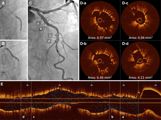 (A and B) Two drug-eluting stents (2.5 × 22 mm and 3.0 × 26 mm) are deployed overlapping. (C) The final angiography result is acceptable. (D) Post-procedural optical coherence tomography. (E) The final longitudinal reconstructed optical coherence tomography image. MSA, minimum stent area; OCT, optical coherence tomography.