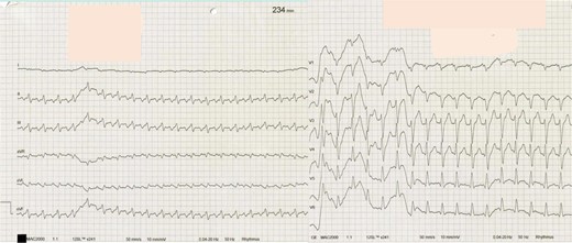 Twelve-lead electrocardiogram with narrow complex tachycardia with a cycle length of 260 ms with negative p-waves in leads II, III, and aVF and inferior QRS axis (interval between R-wave and P-wave, RP 180 ms, interval between P-wave and R-wave, PR 80 ms).