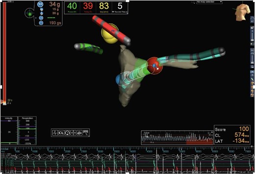 Activation mapping using radiofrequency ablation catheter (TactiCath® Contact Force Ablation Catheter) and EnSite Precision Cardiac Mapping System®, Abbott. At the roof of the coronary sinus ostium, the earliest atrial activation was documented. Irrigated radiofrequency ablation (40°C/43 W) was performed in this region, leading to tachycardia termination within 2 s at the first attempt. Anatomic orientation: the green catheter with the labeling ‘RA’ is located in the right atrium; the red catheter with the labeling ‘RV’ is located in the right ventricle; the turquoise catheter with the labeling “CS” is located in the CS; and the red dot marks the ablation region at the roof of the CS ostium.