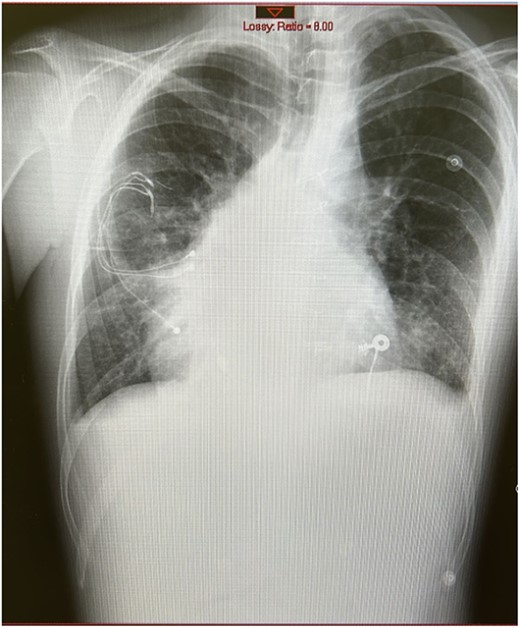 Anterior-to-posterior chest X-ray showing dextrocardia and abandoned epicardial leads of the cardiac resynchronization device.