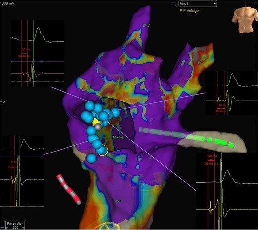 Anterior-to-posterior view of the sub-pulmonic ventricle with selected fascicular signals guiding the implantation of conduction system pacing.