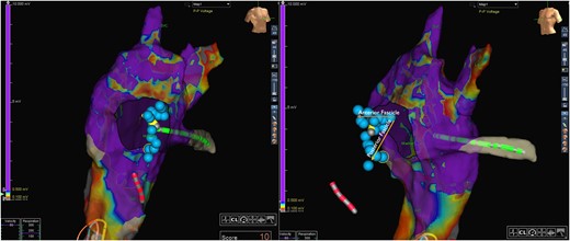 Dual-pane 3D electro-anatomical voltage map of the left, sub-pulmonic ventricle in the right anterior oblique/left anterior oblique views. Arrows indicate the left bundle branches. The superior arrow aligns with the anterior left bundle branch. The inferior arrow aligns to the posterior left bundle branch. The yellow catheter shadow aligns with the anatomical location of conduction system pacing lead placement.