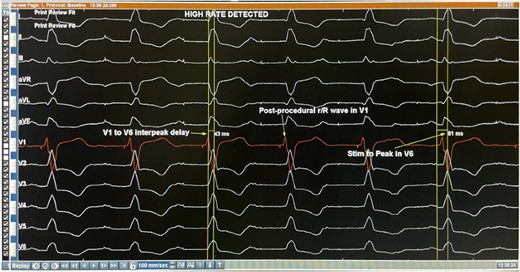 Post-procedural 12-lead electrocardiogram displaying r/R wave in lead V1 and a stim to peak delay of 81 ms in lead V6. Precordial V1–V6 displays an inter-peak delay of 43 ms.