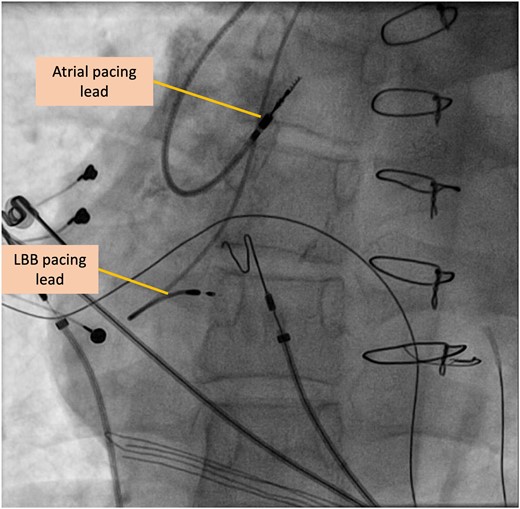 Anterior-to-posterior fluoroscopy view of the pacing leads in the atrial and left bundle branch position.