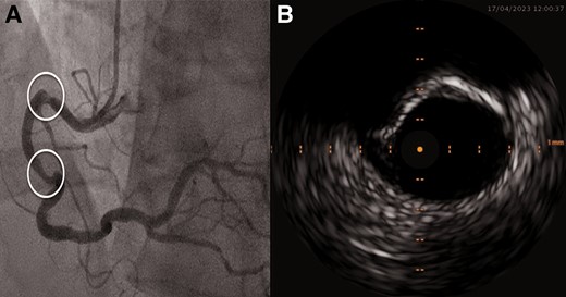 (A) Index right coronary artery lesion angiography. (B) Intravascular ultrasound of the proximal right coronary artery stenosis.