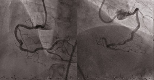 Right coronary artery intracoronary lithotripsy results.