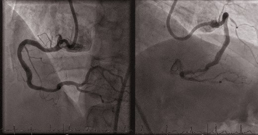 Robotic percutaneous intervention final results.