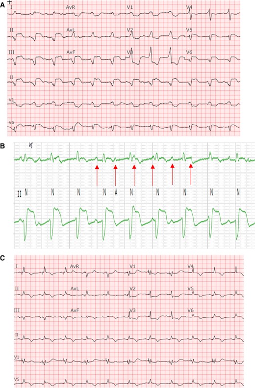 Baseline ECG demonstrating complete heart block with underlying accelerated junctional rhythm in a bifascicular block pattern in comparison to ECG post-pacing. (A) Baseline 12-lead ECG, suggestive of infra-hisian block given the very wide QRS in a bifascicular pattern indicative of diffuse conduction system abnormality. (B) Rhythm strips zoomed in to reveal the AV dissociation. (C) ECG post-pacing. An incomplete RBBB pattern with a narrower QRS complex.