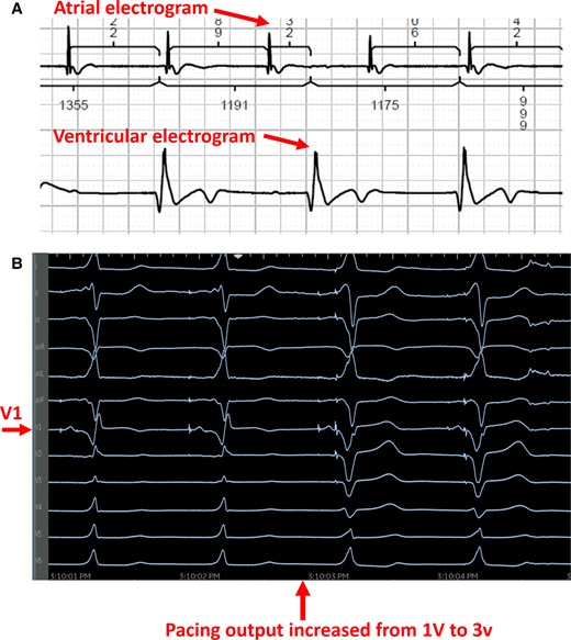 Intraoperative recordings during left bundle branch area pacing. (A) Intracardiac recording from the atrium as well as the ventricle demonstrating underlying complete heart block. (B) As pacing output increased from 1 to 3 V (tip to ring bipolar pacing configuration), the QRS transitioned from a narrow RBBB (cathodal tip pacing near LV endocardium) to a wide LBBB pattern consistent with capture from the anodal ring electrode near the RV endocardium.