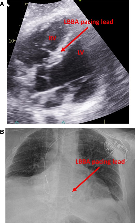 Post-op imaging demonstrating expected lead position. (A) ECHO imaging showing the ventricular lead deeply embedded in the basal ventricular septum with the tip abutting the LV endocardium. (B) Post-operative X-ray showing the septal location of the RV lead.
