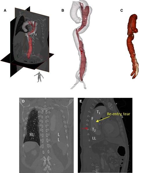 Analysis of 10 phases of 4D computed tomography angiography images using Mimics software showed the spatial morphology of type B aortic dissection. (A, B) 3D geometry of the aortic dissection model constructed from computed tomography angiography images. (C) Volume-rendered 3D models based on computed tomography. (D) Haemothorax in the left lung. (E) Location of blood infiltration (red arrow).