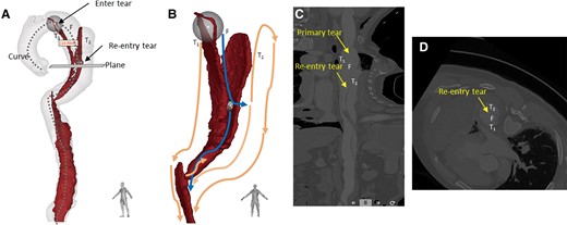 3D segmentation model of the aortic flap tear and 4D computed tomography dynamic images at 10 phases of the cardiac cycle. (A) Aorta 3D model with intimal flap showed that the false lumen was between two true lumens like a ‘sandwich’. The diameters were as follows: proximal tearing entrance in the aorta, >41 mm; exit in the descending aorta, >41 mm; false lumen, >25 mm; primary tearing entrance, >15 mm; and re-entrance in the descending aorta, >5 mm. The distance between the entrance and re-entrance was >110.99 mm. (B) Blood flows from the true lumen (T1) into the false lumen through the primary tear and then returns to the true lumen (T2) through the re-entry tear. The blue and orange lines represent the potential blood flow paths in the false and true lumens, respectively. After blood enters T2 through the re-entry tear, some of it travels up to the top of the aortic arch, while the rest follows the flow in the true lumen to the descending aorta. These streams converge at the diaphragm, where, due to an obstruction caused by partial thrombosis formation, a portion of the blood flows back into the false lumen through the tear opening, while the remainder continues towards the abdominal aorta. (C) Curve plane re-construction of (A) with straightened cine angiography of the vessel. (D) Plane of (A) perpendicular to the re-entry tear, with very little residual endothelial flap at the entrance, as seen in cine imaging, was smaller than that of the re-entry tear.