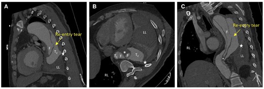 4D computed tomography scans showing the movie images of the true and false lumens and intimal flaps moving with blood flow from different perspectives. (A) Coronal section. (B) Axial section. (C) Sagittal section. Four highlighted areas appear in aortic lumen (T1 and T2 in the true lumen and two F in the false lumen), not signifying four separate cavities but depicting complex patterns due to partial thrombosis in the false cavity alongside active blood flow. The pentagram represents the site of blood leakage from the aortic rupture. The rupture site of the aneurysm was visible on the dorsal side of the descending aorta, and the complex blood flow inside the lumen and haemorrhage around the blood vessel wall is visible. During cardiac cyclic motion, the flap site vibrated within the true and false lumens, and partial thrombosis occurred in the false lumen (asterisk in B). RL, right lung; LL, left lung.