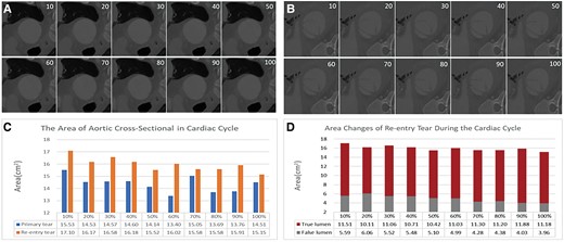 Images and areas of the primary and re-entry tears (true and false lumen) at 10 phases of the cardiac cycle. (A) Cross-sectional image of the primary tear. (B) Cross-sectional image of the re-entry tear. (C) Graph showing that the changes in the area of the re-entry tear are greater than those in the primary tear during the cardiac cycle. (D) Graph showing that the changes in area of the false lumen are greater than those in the area of the true lumen. The intimal flap entering and exiting the opening from the 10 phase cross-sectional images showed that the luminal area at the entrance (A) was smaller than that at the exit (B), and the morphological changes in the intimal flap at the re-entry site were also greater than those at the primary tear site. The luminal areas of the primary tear and re-entry tear in aortic dissection were 14.38 ± 0.65 and 15.98 ± 0.57 cm2, respectively, and the areas of the true and false lumens at the re-entry site were 11.04 ± 0.52 and 4.94 ± 0.73 cm2, respectively, as shown by further measurements. Although the area of the re-entry tear was larger than that of the primary tear overall, its fluctuation with blood flow was less than that of the primary tear, and the amplitude of the change in the area of the true lumen was greater than that of the false lumen.