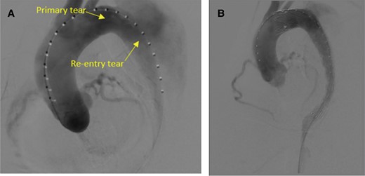 Intraoperative angiography. (A) Digital subtraction angiography video before stent placement showing the re-entry tear from the false lumen to the true lumen. (B) Satisfactory isolation of the main rupture site and false lumen associated with the aortic dissection was revealed.