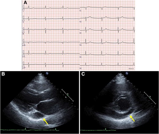 Electrocardiogram and transthoracic echocardiography. (A) The electrocardiogram revealed sinus bradycardia. Parasternal long-axis (B) and short-axis (C) views showing a dilated coronary sinus (arrows). Left ventricular ejection fraction was preserved with no asynergy.