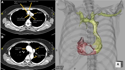 Cardiac computed tomography. (A) Axial view at the level of the superior margin of the sternum. (B) Axial view at the level of the sternal angle. (C) Reconstructed 3D image of the subclavian vein, persistent left superior vena cava, right atrium, and right ventricle. PLSVC, persistent left superior vena cava.