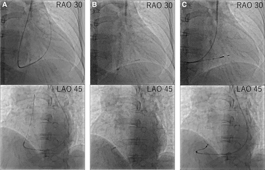 Procedural steps of right ventricular lead placement. (A) First, we delivered the guidewire to the pulmonary artery. (B) Second, we advanced the C315-S10 delivery catheter along the guidewire and then removed the guidewire. (C) Third, we delivered the right ventricular lead along the C315-S10 delivery catheter and screwed in the right ventricular lead.