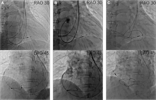 Procedural steps of right atrium lead placement. (A) First, we advanced the C315-H40 delivery catheter along the guidewire. (B) Second, we delivered a 4 Fr pigtail along the C315-H40 delivery catheter and performed right atrial appendage angiography. (C) Third, we delivered the right atrium lead along the C315-H40 delivery catheter and screwed in the right atrium lead.