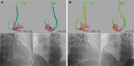 Delivery catheter merged with cardiac multidetector computed tomography. We imported the delivery catheter data and reconstructed them into 3D computed tomography, then merged them with the patient’s cardiac 3D multidetector computed tomography. (A) The distal end of the C315-S10 delivery catheter was in a similar position relative to the right ventricular septum between the 3D CT image and the fluoroscopic image. (B) The distal end of the C315-H40 delivery catheter was in a similar position relative to the right atrial appendage between the 3D computed tomography image and fluoroscopic image.