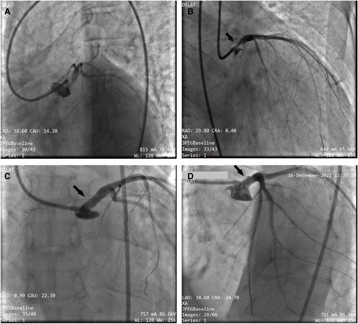 (A and B) Coronary angiography showing a very tight stenosis estimated at 80% of the ostial trunk (black arrow) with a smooth coronary network. (C and D) Result of coronary angioplasty of the common trunk with implantation of a 4 × 18 mm active stent (black arrow), which was released at 18 atm after predilection by a 3.5 × 15 mm balloon. The proximal part of the stent was optimized with a 5 × 12 mm balloon.
