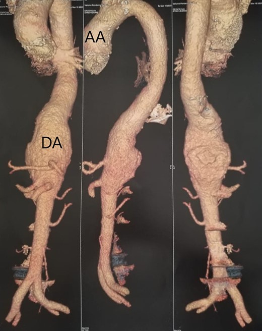 Aortic angiography images showing dilation of the suprarenal thoracic and abdominal aorta. AA, ascending aorta; DA, descending aorta.