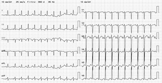 Electrocardiogram. Heart rate 145 b.p.m. QRS duration 90 ms. RP>PR. Atrial tachycardia.