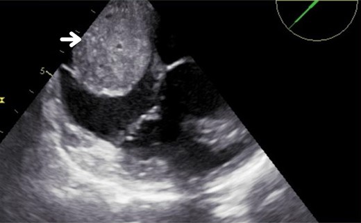 Transoesophageal echocardiogram. The arrow indicates the 50 × 40 mm image in the right atrium.